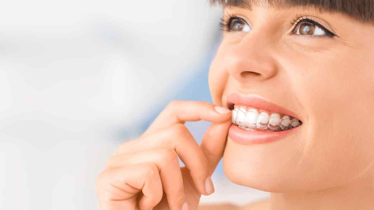 clear aligners